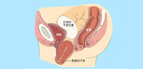 产后子宫脱垂是怎么回事？怎样调理呢？